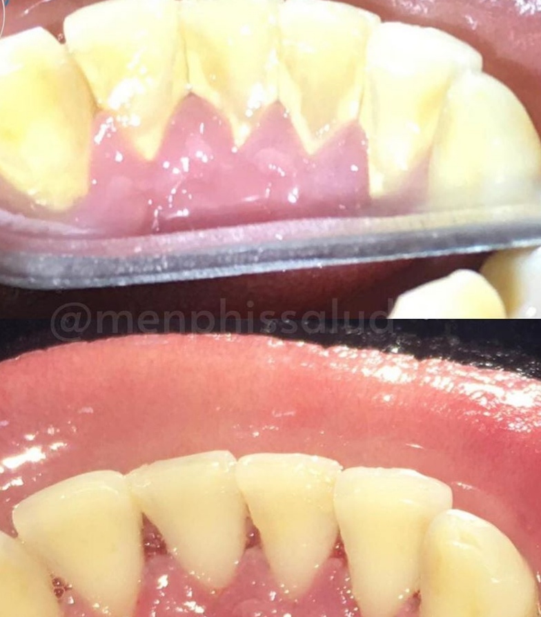 profilaxis dental ultra sonido